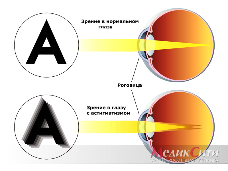 Близорукость у детей: как улучшить зрение при миопии | CooperVision Russia