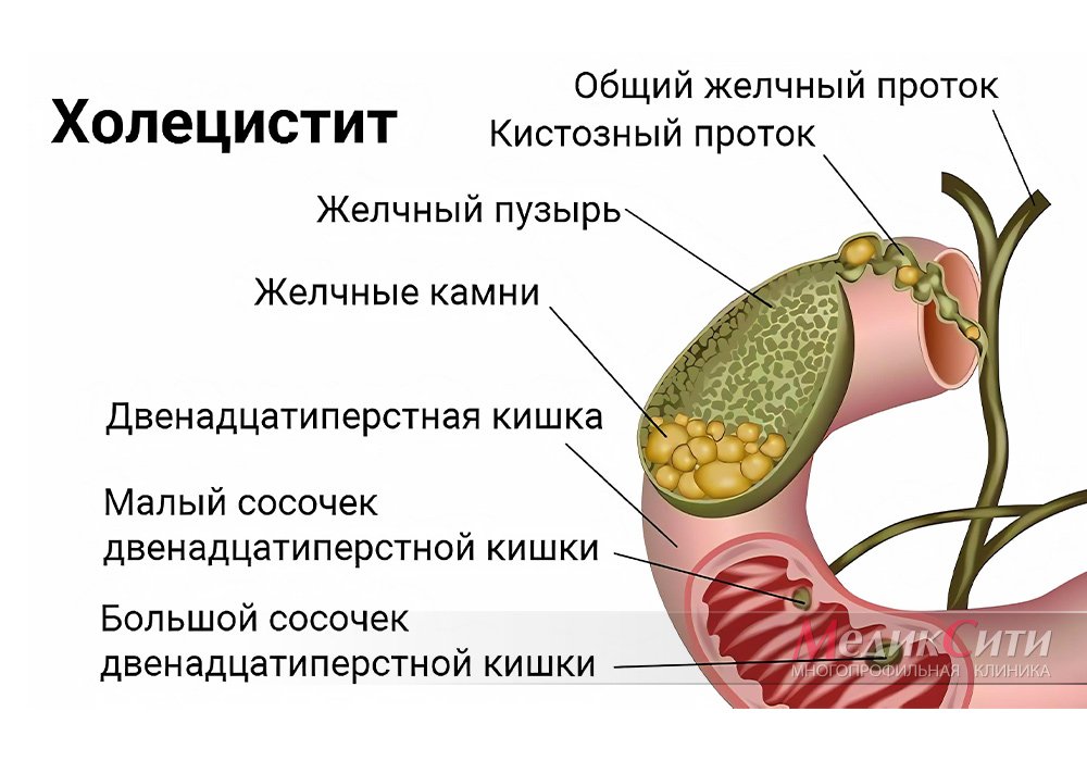 Воспаление желчного пузыря причины можно есть капусту при холецистите