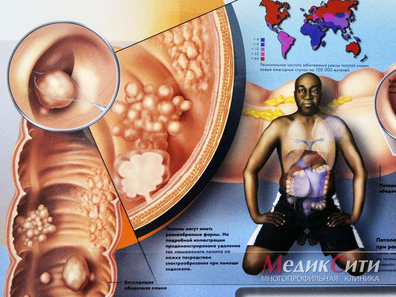 Pathology of prostate cancer ncbi. Potencia és prosztatitis tabletták